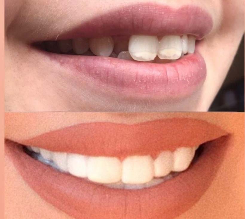 Before and after comparison, showing teeth with and without Withasmile dental veneers