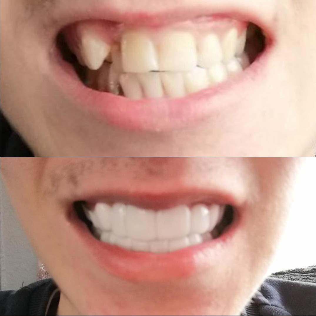 Before and after comparison, showing teeth with and without Withasmile dental veneers