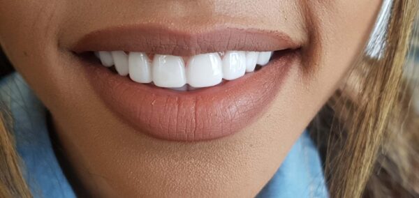Close up of a mouth displaying Withasmile dental veneers